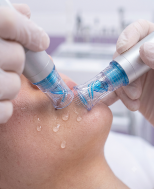 Microneedling with PRP & Skin Boosters treatment