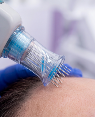 Microneedling with PRP & Skin Boosters treatment